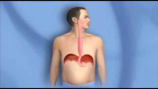 Surgery for Esophagus Cancer, Esophagectomy - Mayo Clinic