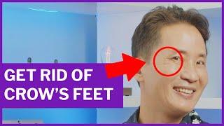 GET RID OF CROW'S FEET | Dr. David Yew