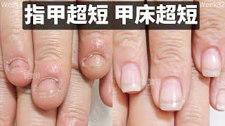 Short nail Short nail bed｜Kieron nail correction cases｜Working with severely damaged fingers