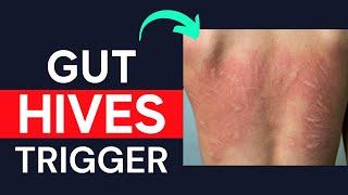 Gut Trigger For Chronic Hives On Skin (Including Chronic Urticaria, Dermatographia, Angioedema)