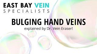 Bulging Veins in Hands? Here's How to Diagnose & Treat Hand Veins