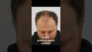 Glow up? #przeszczepwłosów #hairtransplant #hairtransformation #metamorfoza #łysienie #zakola