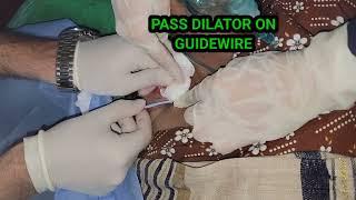 How Pass CVP Line || Central Catheter