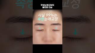 무쌍눈매교정에 혹시 속고 계신가요? #인스타성형외과 #무쌍 #눈매교정 #눈매교정전후