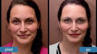 Anti-aging transformations Perfect Clinic Dermatology - spot