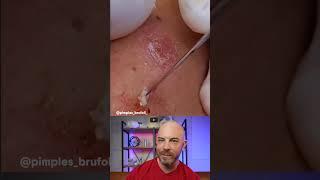 Please don't play with your cysts #dermreacts #doctorreacts #pimplepopper #cystpop