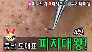 피지 직접 뽑아드렸습니다 _ 피지제거 블랙헤드제거 피지뽑기 _ 충남 도대표 남자구독자님! 피지제거 현장속으로 빠져봅시다! 기대만빵 4탄 시작합니다