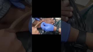 WART REMOVAL by CO2 fractional laser #beauty #skincare #cosmetologist #shorts #subscribe