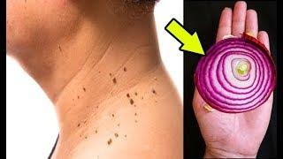 Remove Skin TAG Overnight With Kitchen Ingredient Remedy ( 100% WORKING) everyday culture