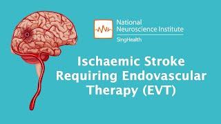 Understanding Stroke: Treating Stroke with Endovascular Therapy (EVT)