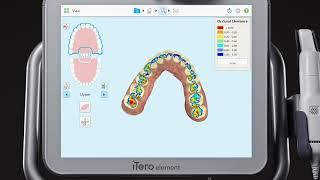 iTero® Scanner Tutorial: Occlusogram