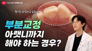 앞니 클리피씨 부분교정하기 전, 이건 몰랐지