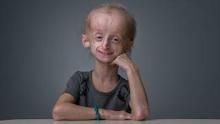 Miracle Story: Carly (Progeria)