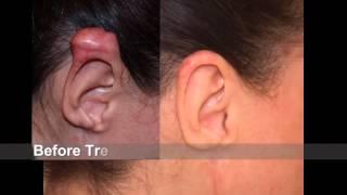 Best "#Keloid Treatment" for most difficult ear keloid