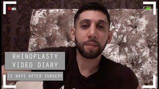 Rhinoplasty video diary - 12 days after surgery (13/15)