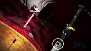 AXIOS™ Stent and Electrocautery Enhanced Delivery System Animation