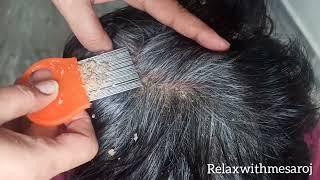 Scratching Dandruff Flaks