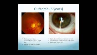 Scleral Lens Indications