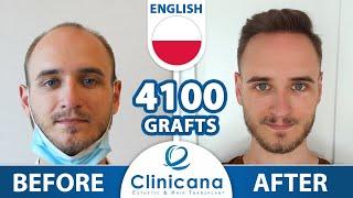 Our client presents the 10 months results of his hair transplantation at Clinicana