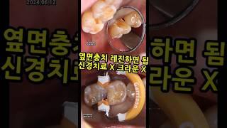 옆면충치는 레진하면 됨. 신경치료 불필요. 크라운 불필요. 17_2024_06_24