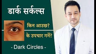 डार्क सर्कल्स (Dark circles) को कारण र उपचार । Causes and treatment of under eye dark circles