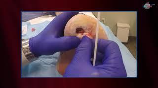 WCW: Removal of Exposed Bone in a Diabetic Foot Ulcer