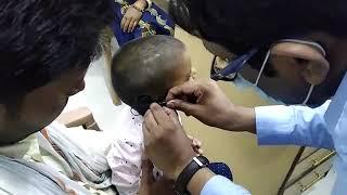 switch on of cochlear implant in Sri Ganganagar 8447353649