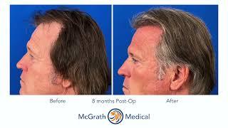 2,000 Graft Hair Transplant Case Study - Presented by Dr. Lane Graves