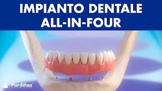 Impianto dentale All-in-four ©