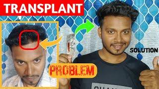 HAIR TRANSPLANT EFFECTS & COST #2024