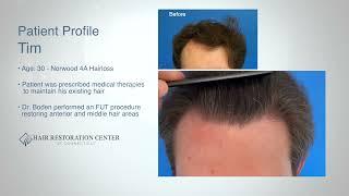 Hairline Restoration with FUT Donor Strip Harvest - Hair Comb Through