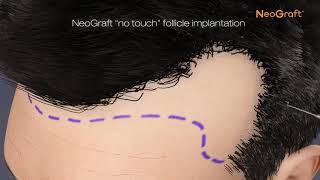 NeoGraft Animation Video