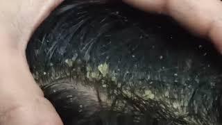 Dandruff Big Flakes!! Dandruff Scratching Satisfying!