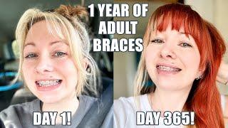 1 Year Of Braces + Some Unfortunate News!