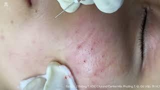 Big Cystic Acne Blackheads Extraction Blackheads & Milia, Whiteheads Removal Pimple Popping