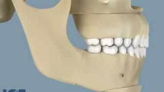 Orthognathic Surgery