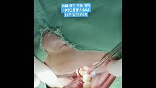 하악부분 매복발치영상(#48) - 1분 컷