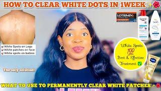 HOW TO GET RID OF WHITE DOTS ON SKIN  Effective Treatment for White Patches on Skin & Best Products