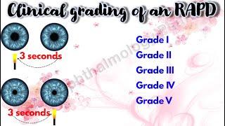 Pupil 4 | Clinical grading of an RAPD | Marcus Gunn Pupil