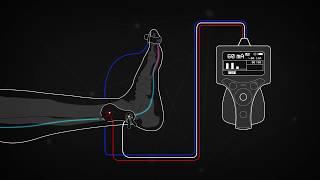 Train of Four Monitoring using the Posterior Tibial Nerve