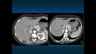 Cystic Pancreatic Lesions: Detection, Diagnosis and Management - Part 4