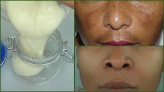 IN 7 DAYS REMOVE DARK SPOTS AND SCARS |PERMANENT DARK SPOTS + SCARS  REMOVER CREAM Khichi Beauty