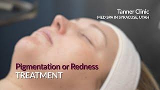 Pigmentation or Redness Treatment at the Tanner Clinic Med Spa in Syracuse, Utah