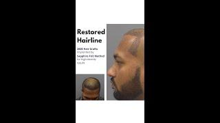 Hair line transplant by Sapphire FUE method #fue #shorts #hairtransplant #hairtransplant #hairlinet