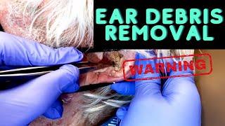 INSANE Ear Debris Debulking | CONTOUR DERMATOLOGY