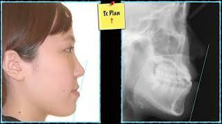 CC309. Occlusal Canting & Wrong Angulation