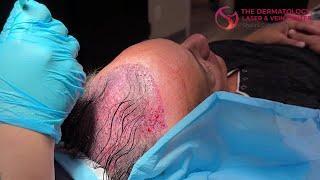 Smart Graft Hair Transplant Treatment | Dr. Shalini Gupta