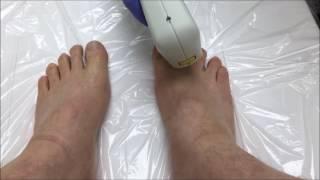 Painless Laser Hair Removal Toes, Skin Deep Laser Services, Northern Virginia, Burke, VA,Fairfax VA