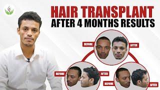 Hair Transplant After 4 Months Results | Care Well Medical Centre