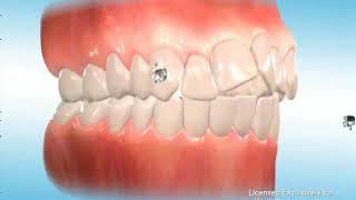 Self ligating braces 1